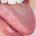 Understanding Dry Mouth and Its Side Effects