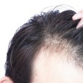 Hair Loss: Causes, Treatment, and Prevention