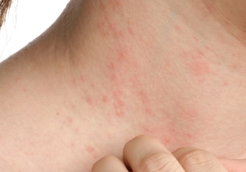 Rash: Everything You Need to Know