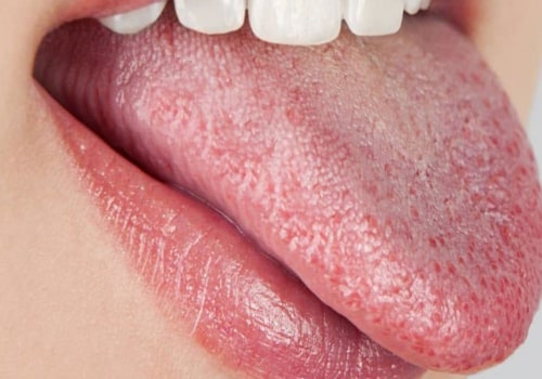 Understanding Dry Mouth and Its Side Effects