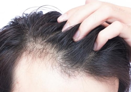 Hair Loss: Causes, Treatment, and Prevention